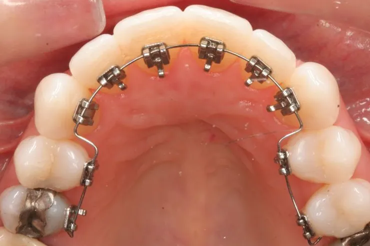 Dental Braces Treatment in Sanand