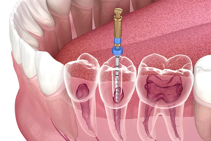 root canal treatment experts in ahmedabad