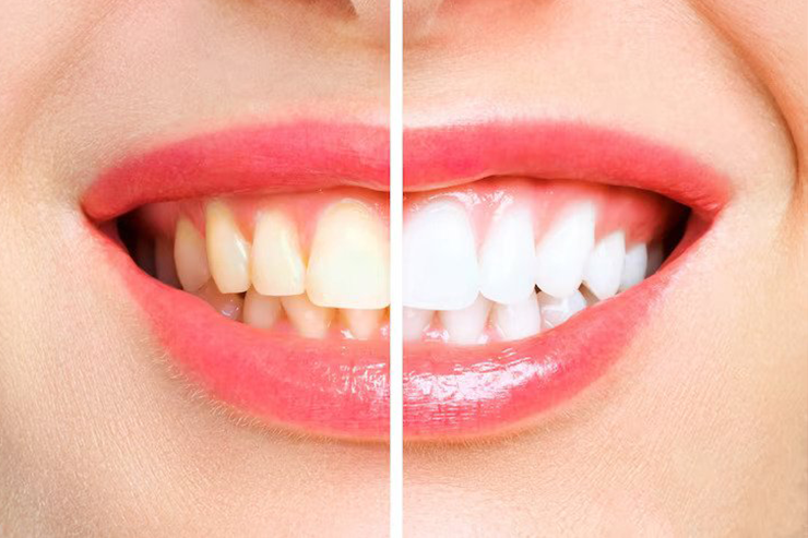 teeth cleaning treatment in ahmedabad