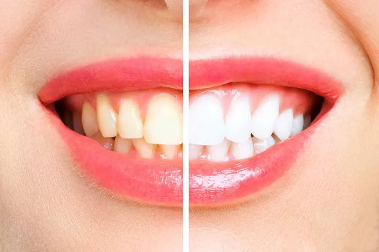Teeth Whitening & Cleaning in Sanand